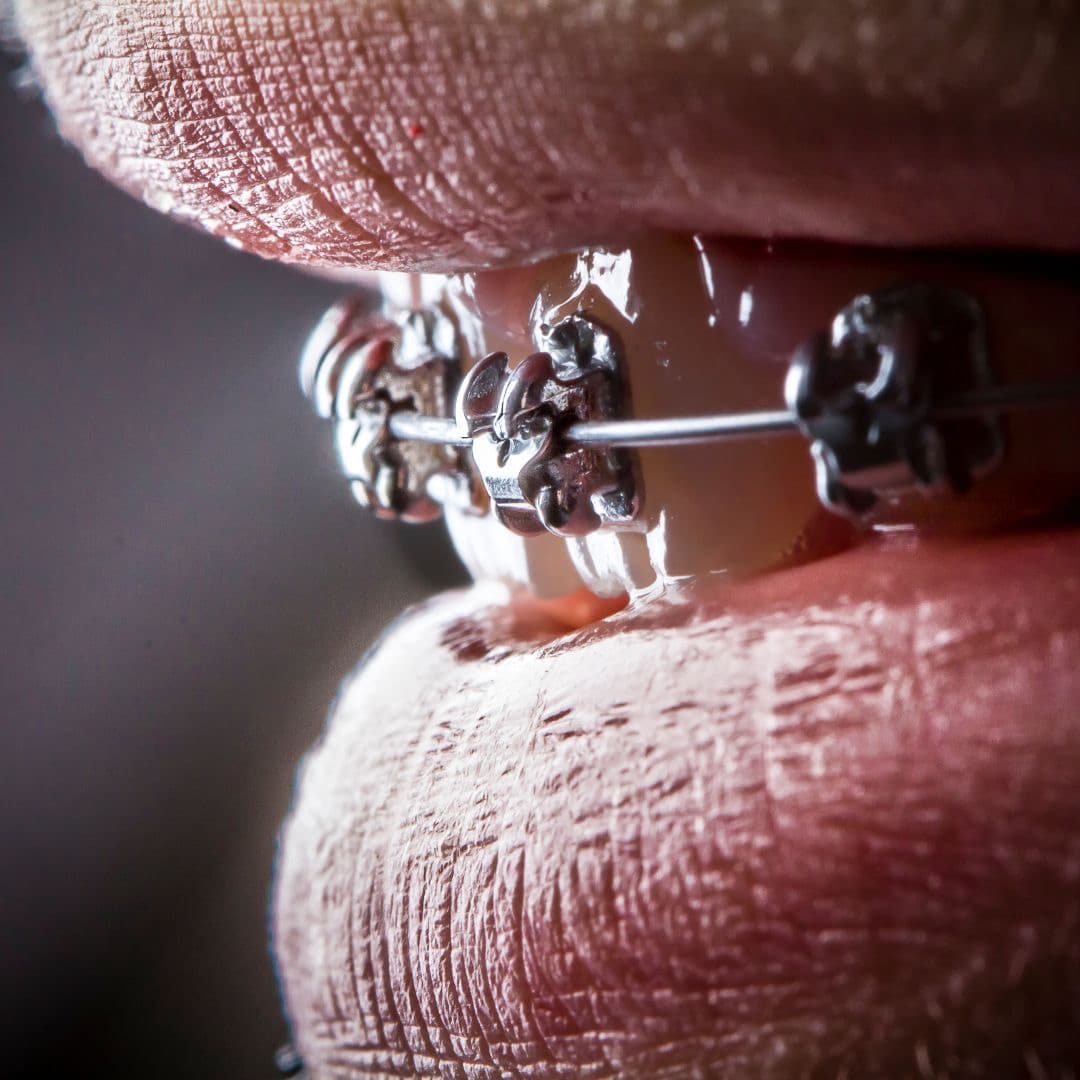 Брекет-система