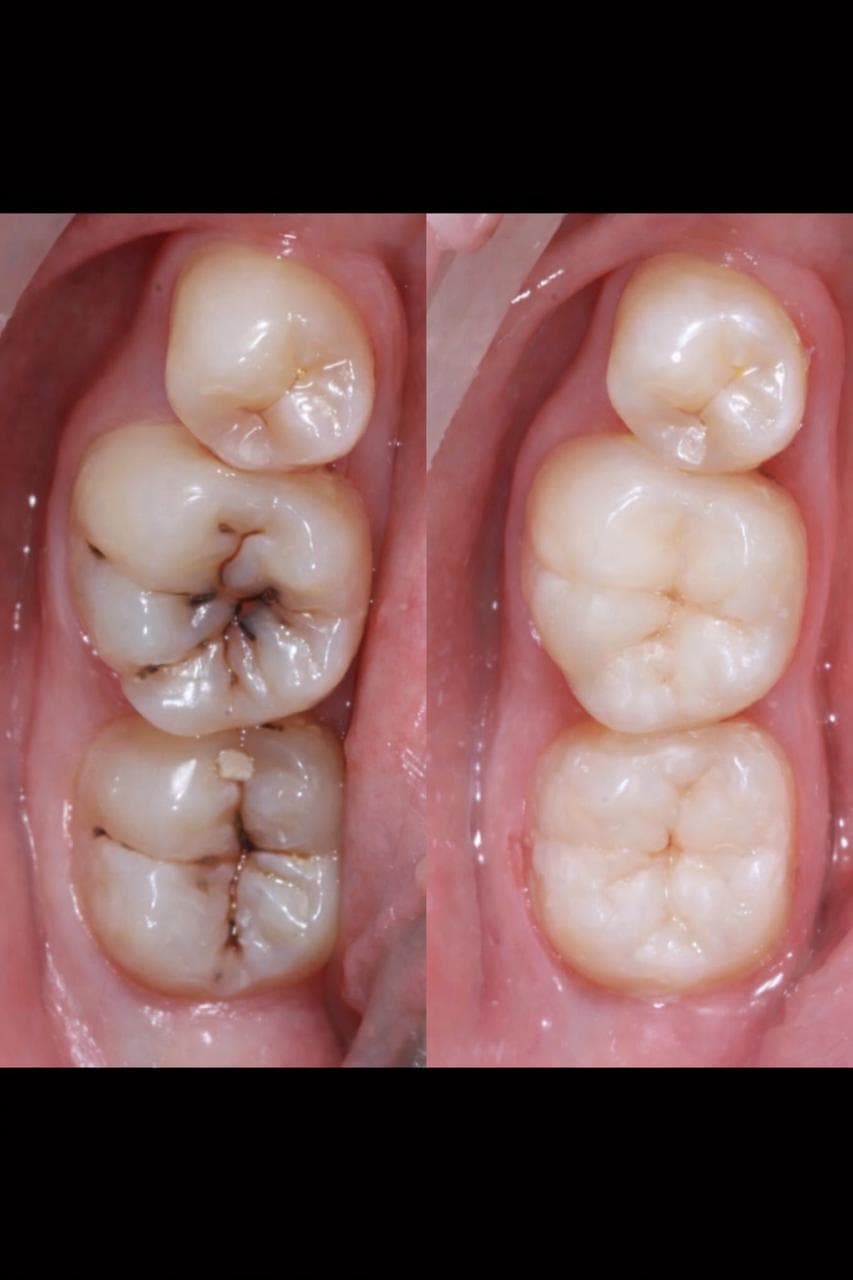 Лечение кариеса