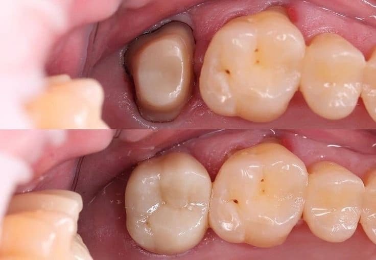 Циркониевая коронка с керамическим нанесением