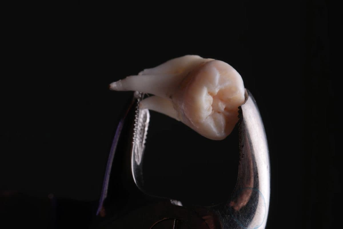 Удаление зубов